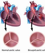 Image result for Bicuspid Aortic Valve Fetal Ultrasound