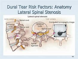 Image result for Lumbar Dural Tear