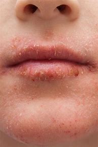 Image result for Allergic Reaction Rash On Lips