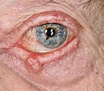 Image result for Basal Cell Carcinoma On Eyelid
