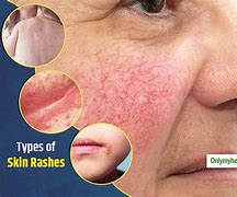 Image result for Types of Skin Rashes