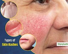 Image result for Most Common Skin Rashes