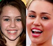 Image result for Miley Cyrus Teeth