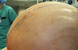 Image result for Ovarian Cancer Removed