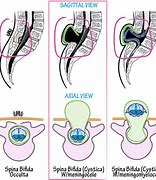 Image result for Meningocele