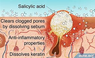 Image result for Salicylic Acid for Eczema