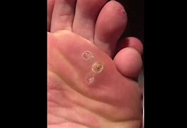 Image result for Wart After Compound W
