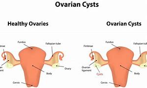Image result for Adnexal Cyst Size 16Mmx15mm