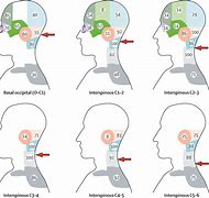 Image result for Acupuncture Headache