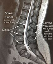 Image result for MRI Scan Lumbar Spine