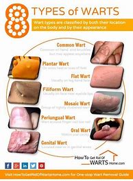 Image result for Filiform Genital Wart