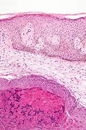 Image result for Molluscum Contagiosum Genital Area Treatment