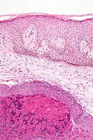 Image result for Molluscum Contagiosum Virus in Ethiopia