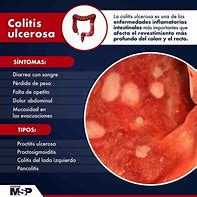 Image result for colitis_ulcerosa