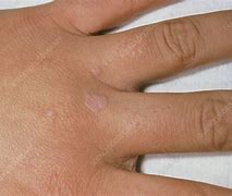 Image result for Flat Wart Finger