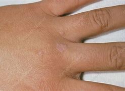Image result for Flat Warts On Hands