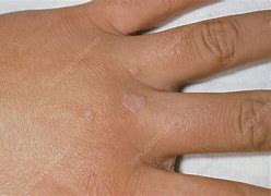 Image result for Common Warts On Hands