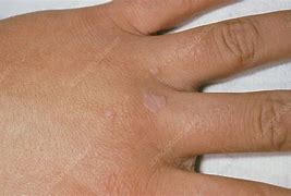 Image result for Common Wart On Palm of Hand