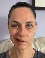 Image result for Jennifer Gibson Bell's Palsy