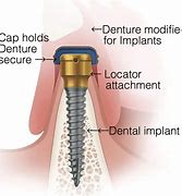Image result for What Is an Implant Locator