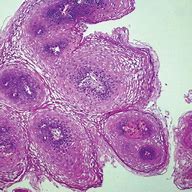 Image result for What Causes Squamous Papilloma