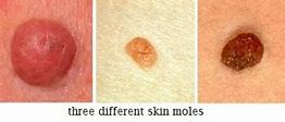 Image result for Papilloma Mole