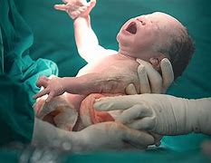 Image result for Caesarean Section