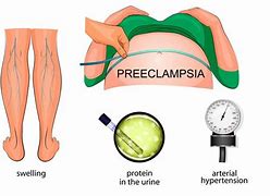 Image result for eclampsia