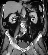 Image result for Complex Kidney Cyst MRI