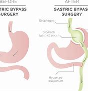 Image result for SB Bypass Surgery for Weight Loss