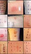 Image result for Allergic Reaction On Arms