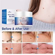 Image result for Best Skin Tag Mole and Wart Remover