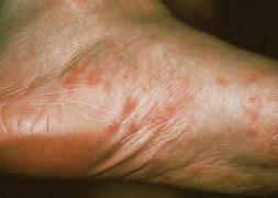 Image result for Syphilis