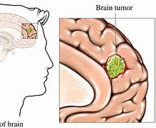 Image result for Human Brain Tumor
