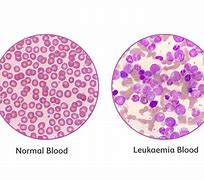Image result for Leukemia Diagram