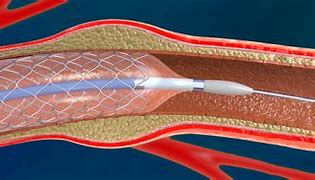 Image result for Revascularization