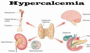Image result for hipercalcemia
