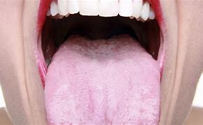Image result for HPV On Back of Tongue