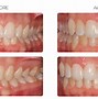 Image result for Treatment of Long Front Teeth with Braces Before and After