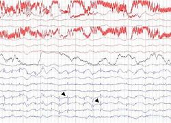 Image result for EEG Phatomy Spikes