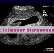Image result for Acrania First-Trimester Ultrasound