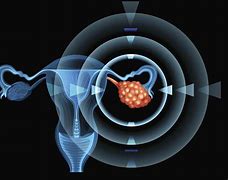 Image result for Ovarian Cancer Tumor