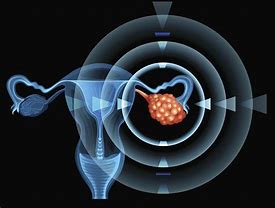 Image result for Ovarian Cancer Metastasis