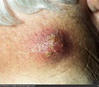 Image result for Sebaceous Cyst On Back of Neck