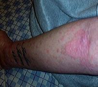 Image result for Bleach Burn On Skin