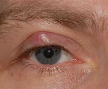Image result for Bump in Corner of Eye Near Tear Duct