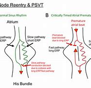 Image result for Re-Entry Arrhythmia