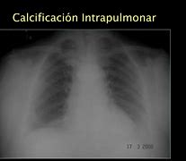 Image result for calcificaci�n