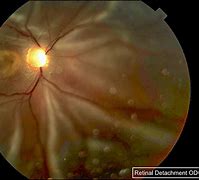 Image result for Retina Cyst