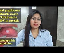 Image result for Papilloma Warts